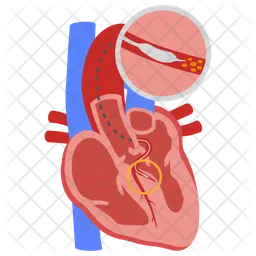 Alcohol septal ablation  Icon