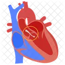 Aortic valve regurgitation  Icon