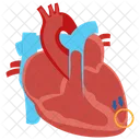 Cardiomyopathie Dilatee Dilatation Cardiaque Insuffisance Cardiaque Icône