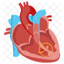 Congenital heart defect  Icon