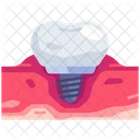 Implanted  Icon