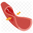 Koronararterienspasmus Koronarvasospasmus Angina Pectoris Symbol