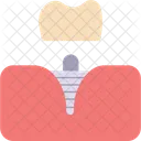 Mulitiple tooth implants  Icon