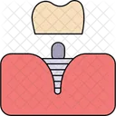 Mulitiple tooth implants  Icon