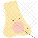 Nose with acne  Icon